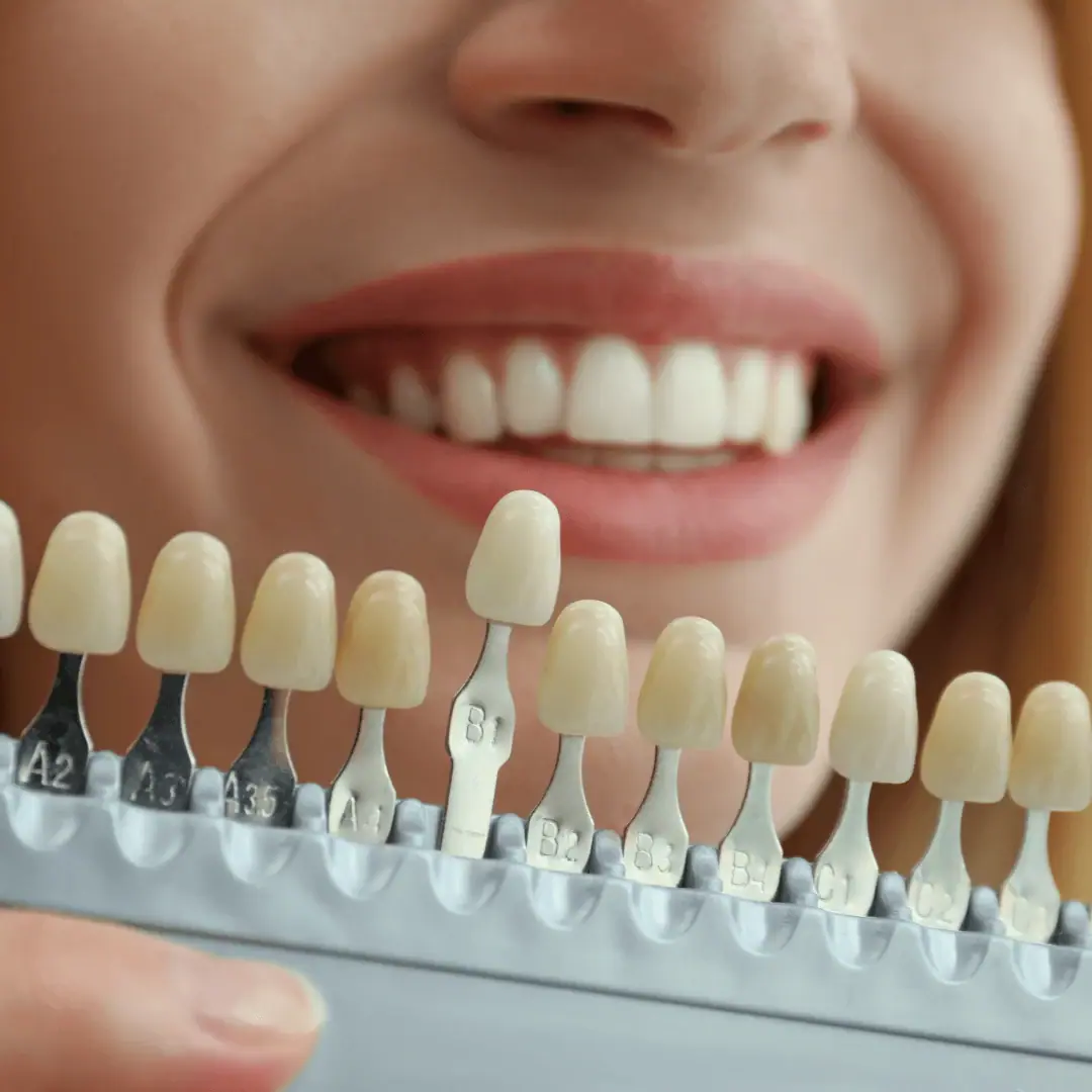 Shade guide held up to a smile to match a bridge to the natural teeth